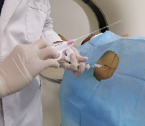 CT定位下肺穿刺图片1