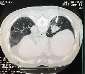 CT定位下肺穿刺图片2