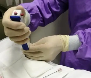 CT定位下肺穿刺图片3