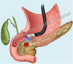 超声引导下胰腺穿刺1