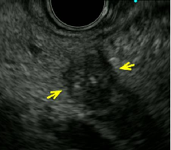 超声引导下胰腺穿刺3