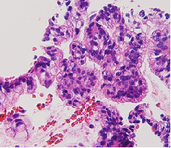 超声引导下胰腺穿刺4